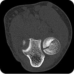 ct scan elbow