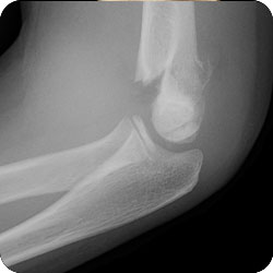 Type II Supracondylar Fracture