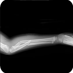 Radius & Ulna Shaft Fractures in 4 year old