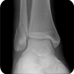 Weber B Ankle Fracture