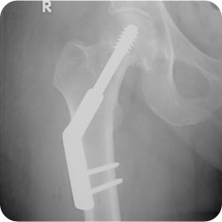 Type 1 Subcapital NOF <br />
 treated with 2 hole DHS”>Type 1 Subcapital NOF<br>treated with 2 hole DHS</p>



<ul class=