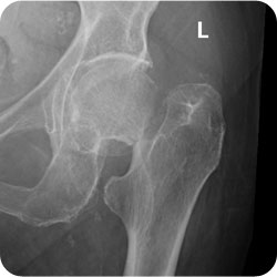 Type 3 Garden Subcapital NOF Fracture