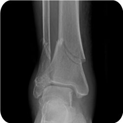 distal tibia fracture