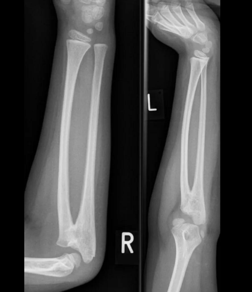 Congenital synostosis of the proximal forearm