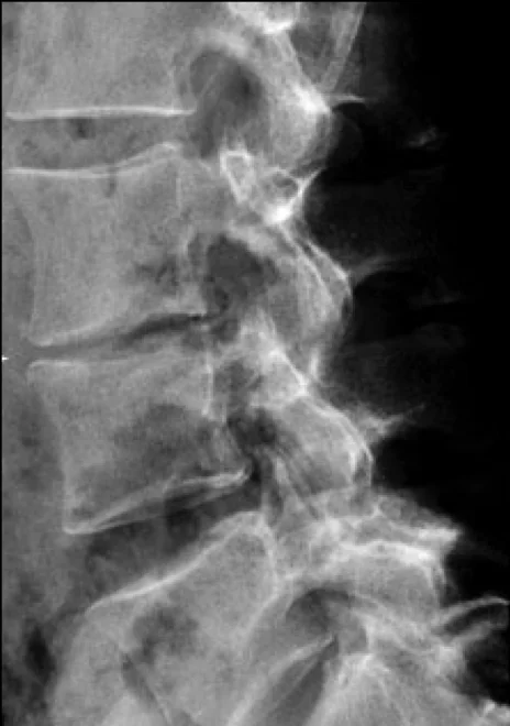 Spine iSAWE 11, case image