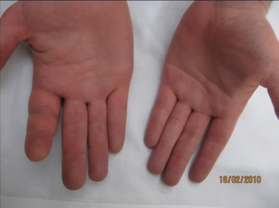 Hand iSAWE 12, case image