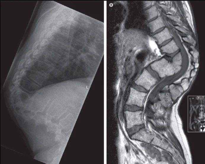 Spine iSAWE 12, case image