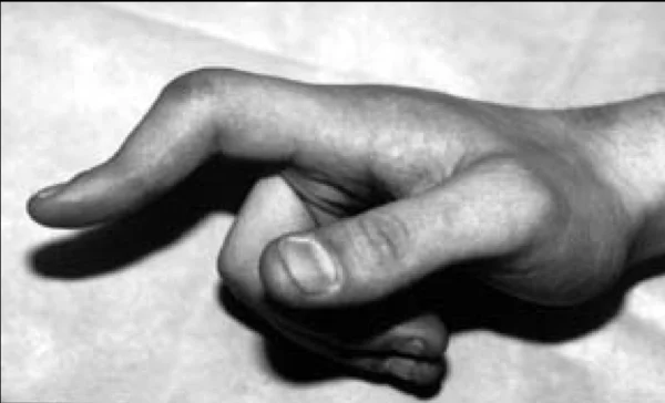 Hand iSAWE 13, case image