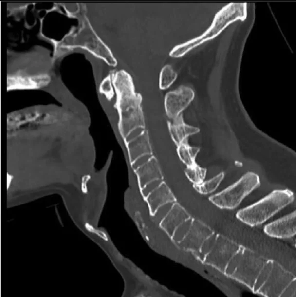 Spine iSAWE 13, case image