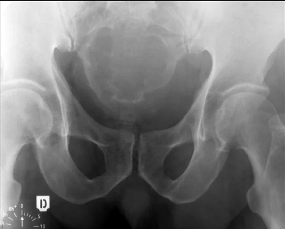 Tumour iSAWE 14, case image