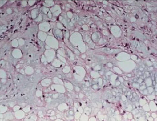 Tumour iSAWE 14, case image
