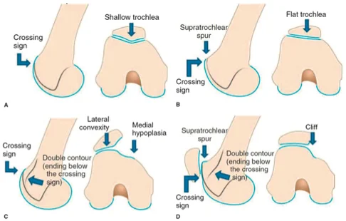 Patellar Instability illustration