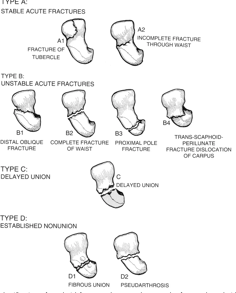 Scaphoid Fractures, modified Herbert classification