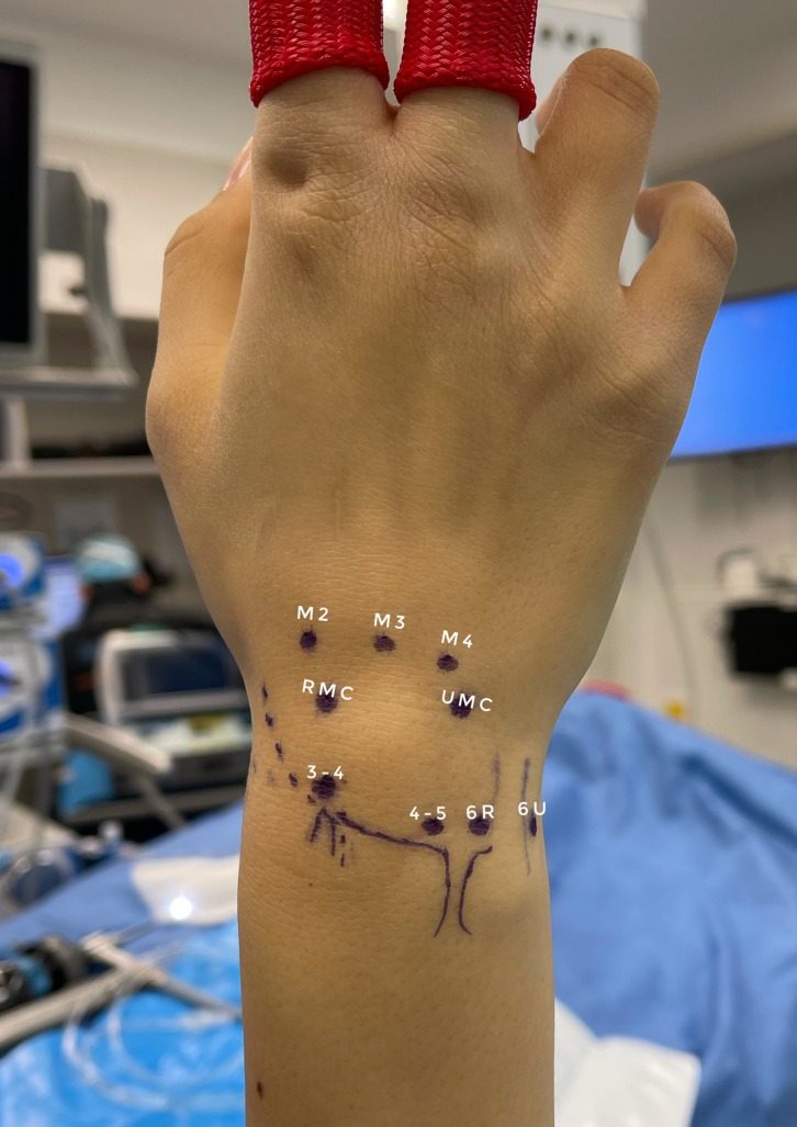 Standard dorsal wrist arthroscopy portals marked on the skin