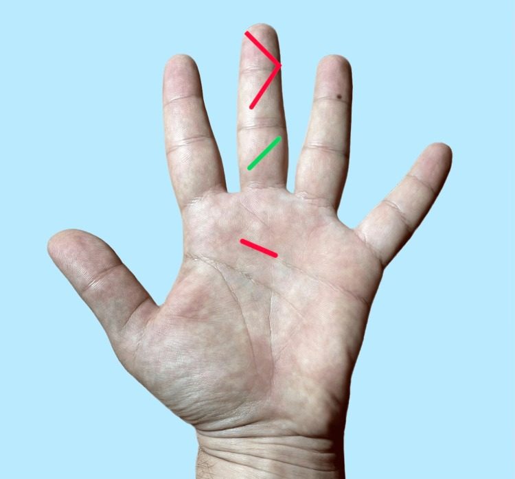 Incisions for draining infection of the flexor tendon sheath
