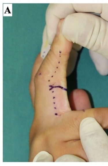 Midlateral line of the finger marked as a dotted line on the side of the digit, with the planned skin incision drawn in relation to it