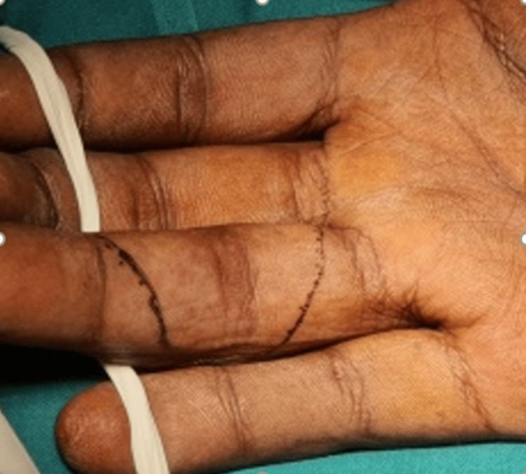 Bruner zigzag incision marked on the palmar surface of the finger for a volar approach to the joint