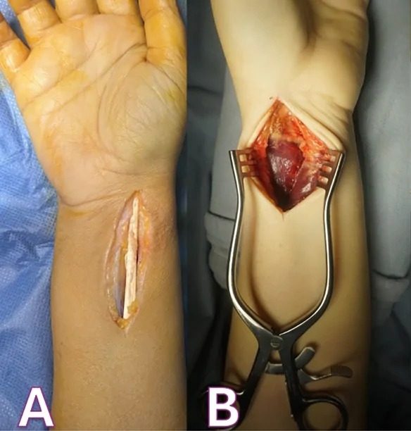Distal part of the volar (Henry) approach to the radius exposing the flexor carpi radialis tendon (A)