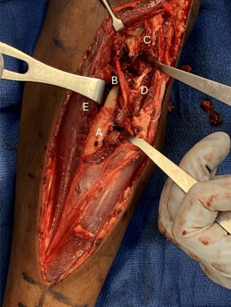 Dorsal (Thompson) approach to the proximal radius