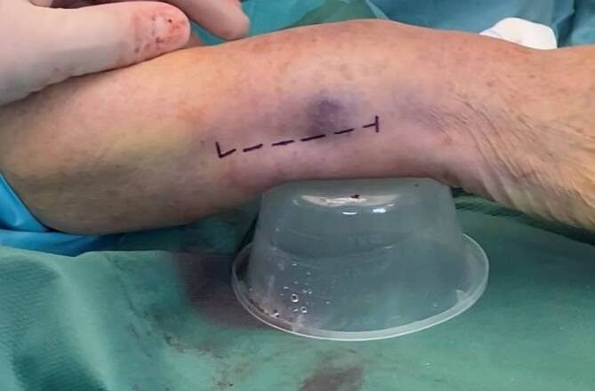 Incision for the ulnar approach to the distal ulna, a straight line between extensor carpi ulnaris and flexor carpi ulnaris along the subcut