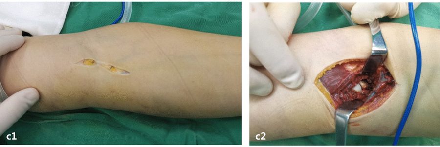 Anterior approach to the elbow through an oblique incision across the elbow crease, with the deep exposure reaching the coronoid process in