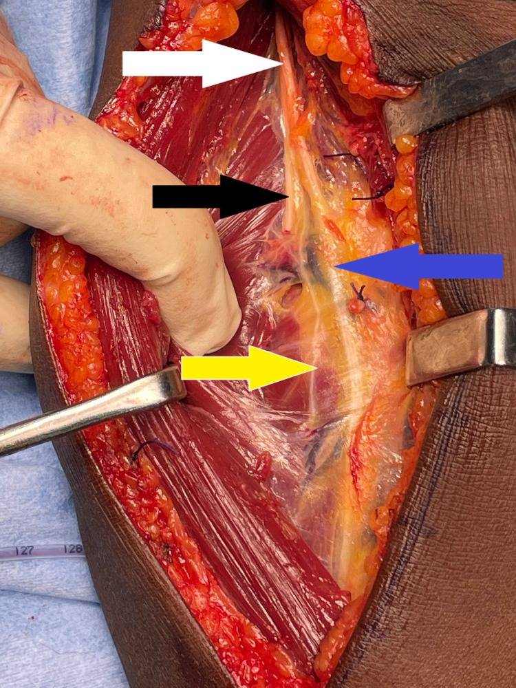 Proximal part of the anterior (Henry) approach to the forearm extended to follow the radial nerve (white arrow)