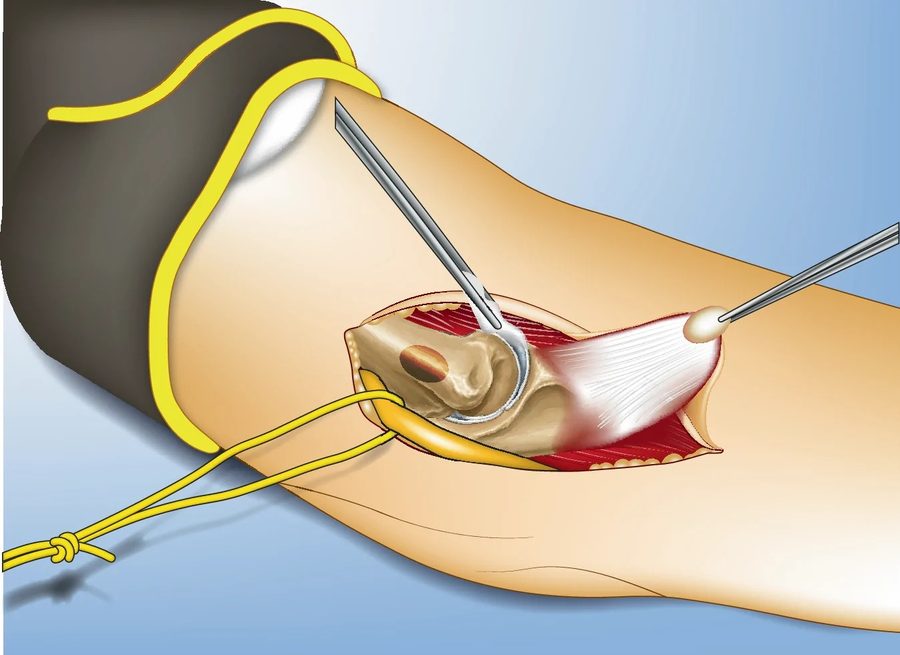 Medial approach with osteotomy of the medial epicondyle