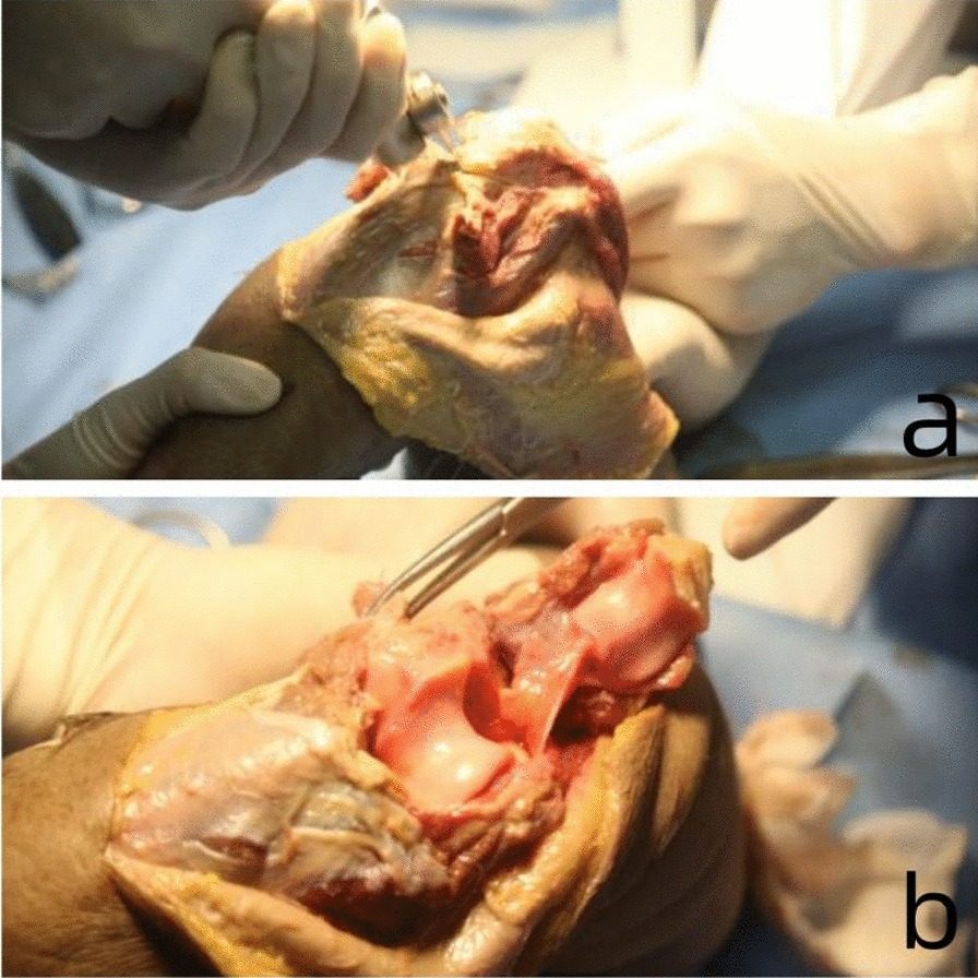 Olecranon osteotomy in a cadaver elbow