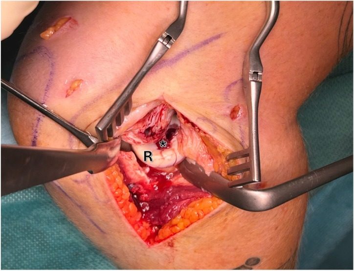 Lateral view of a right elbow through a Kocher type approach, opening the joint to show the radial head (R) and an osteochondral defect (ast