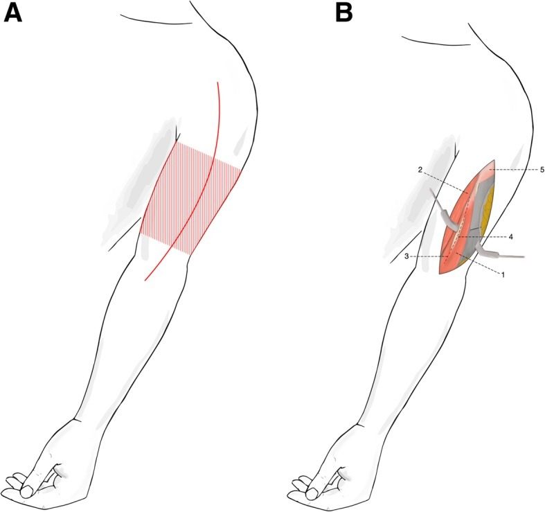Anterior approach to the humeral shaft along the lateral border of biceps