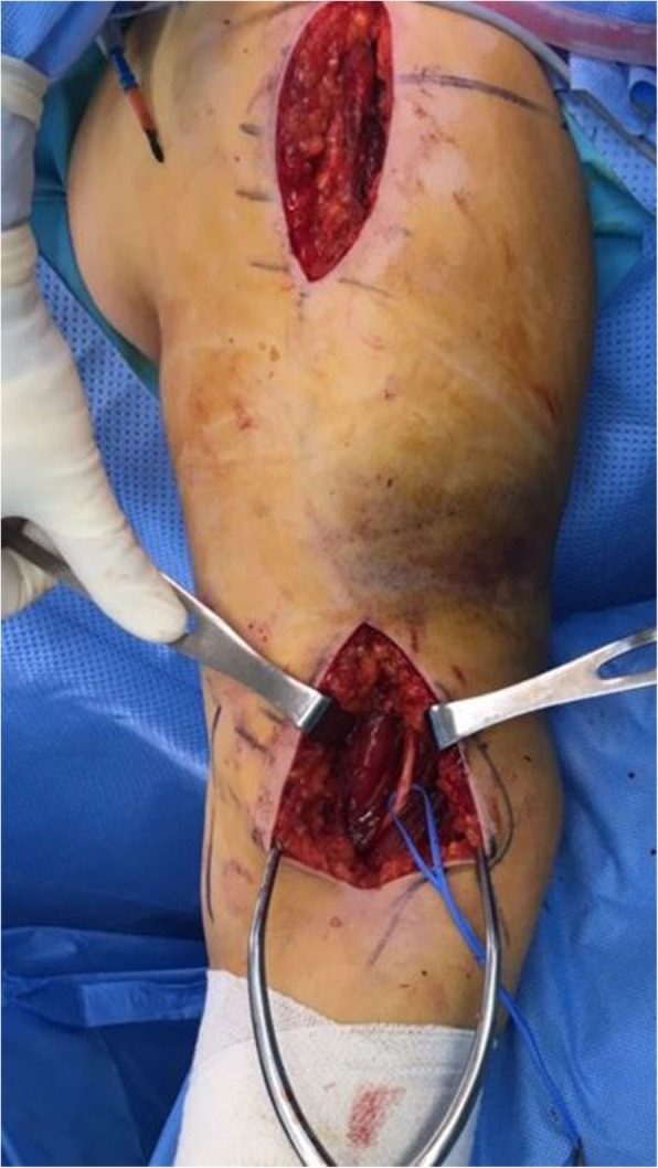 Distal anterolateral incision on the arm with the radial nerve looped in the interval between brachialis and brachioradialis
