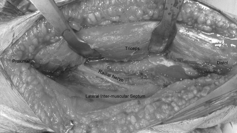 Lateral approach to the distal humerus with triceps lifted off the lateral intermuscular septum