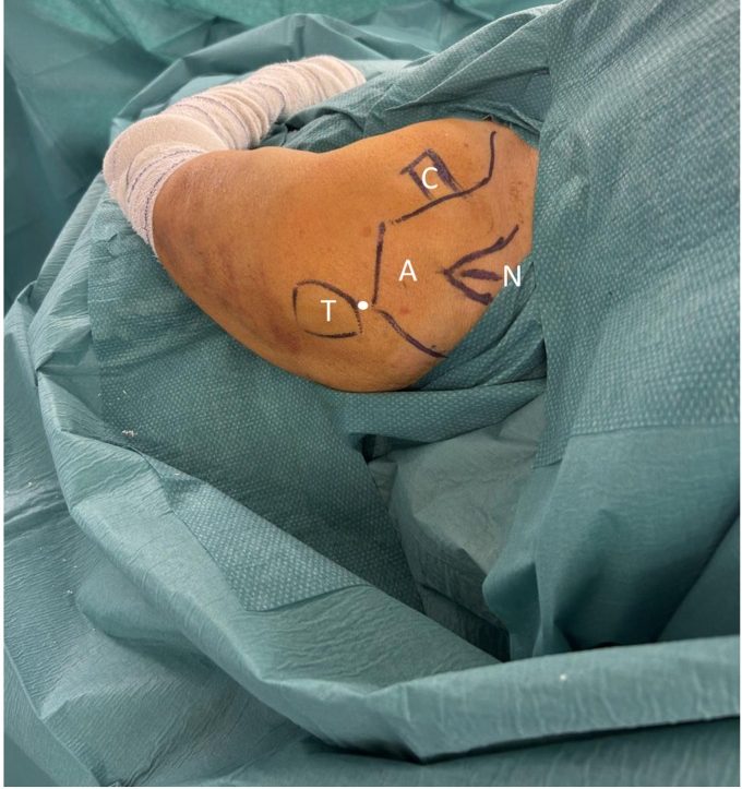 Surface landmarks for the entry point of an antegrade proximal humeral nail
