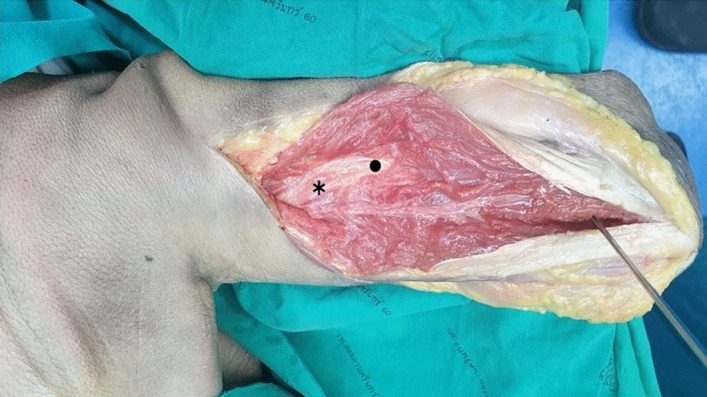 Cadaver dissection of the posterior approach to the humerus through a triceps split