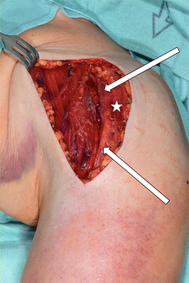 Deep stage of the deltopectoral approach with the cephalic vein (arrows) in the interval between deltoid (asterisk) laterally and pectoralis