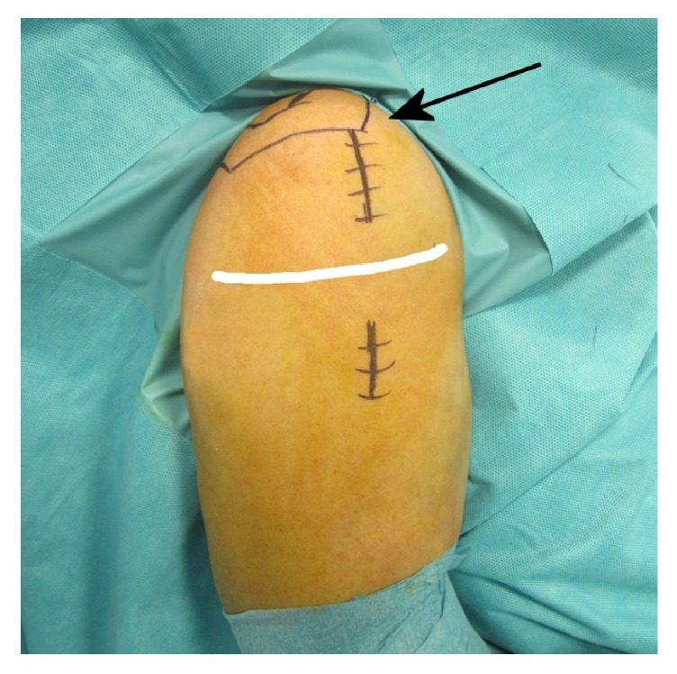 Anterolateral incision starting at the anterolateral corner of the acromion (arrow)