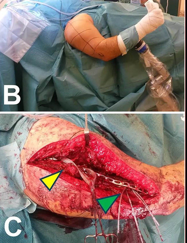 Lateral deltoid splitting approach with the incision lines marked on the arm