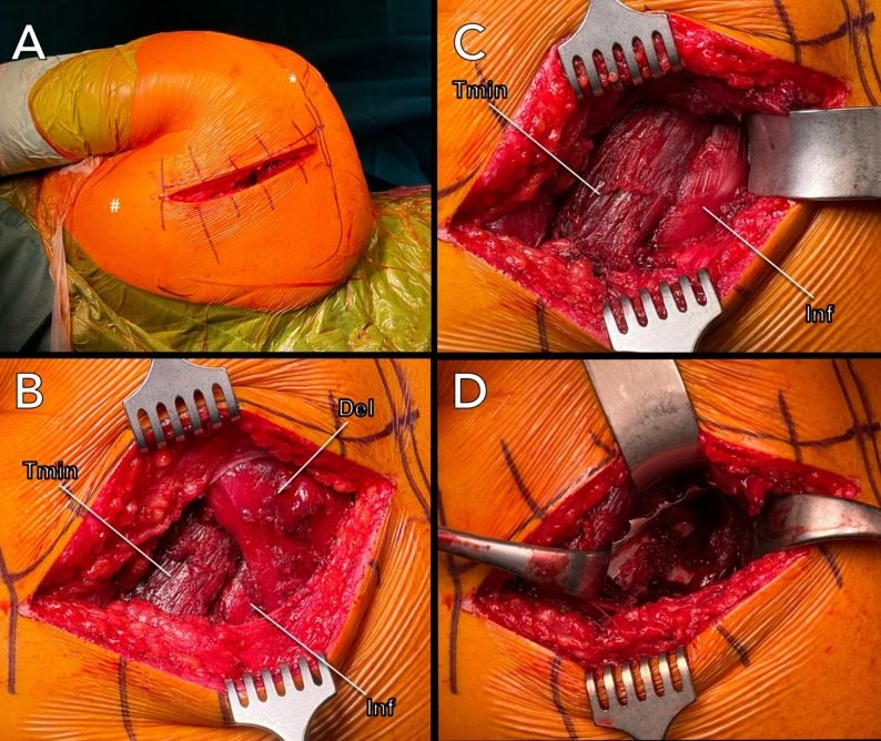 Posterior approach to the shoulder and scapula through an incision from the acromion towards the inferior angle of the scapula