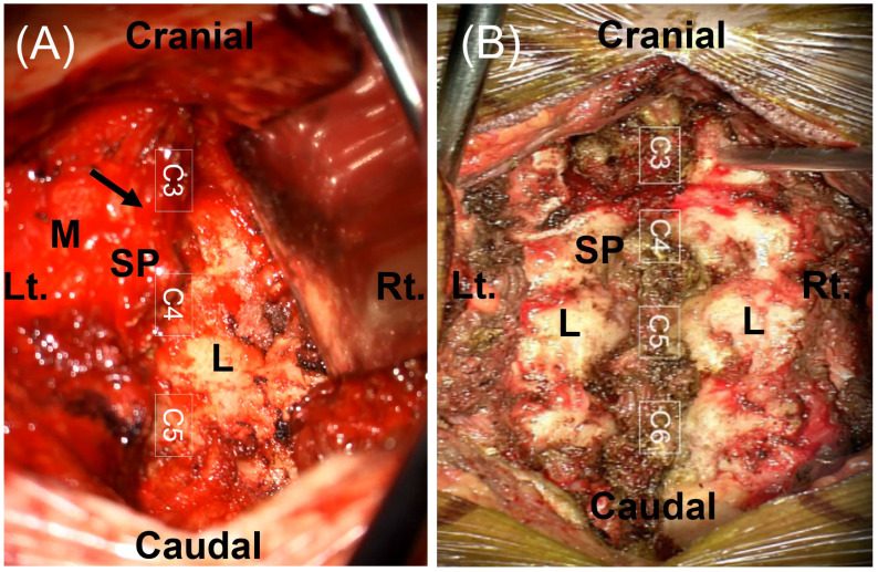 Posterior approach to the cervical spine from C3 to C6 after bilateral subperiosteal dissection, exposing the spinous processes (SP) and lam