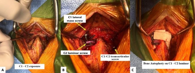 Posterior midline exposure of C1 and C2 (A), followed by C1 lateral mass screws and C2 laminar screws (B) and bone graft laid over the poste
