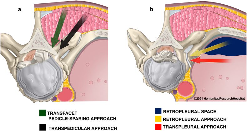 Axial drawings of the routes to a thoracic disc