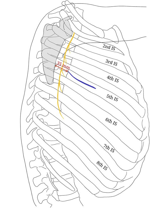 Thoracotomy incision (blue) in the fifth intercostal space for a transthoracic approach to the spine, placed 35 mm from the lateral border o