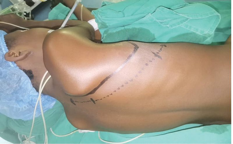 Skin incision for a muscle sparing posterolateral thoracotomy, marked as a dotted line curving below the tip of the scapula with the patient