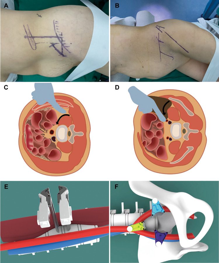 Incision planning and the retroperitoneal corridor for the oblique anterolateral approach at L2 to L5 (A, C, E) and at L5 to S1 (B, D, F)
