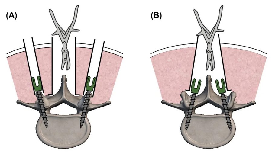 Axial drawing of the posterior midline approach to the lumbar spine, with the paraspinal muscles retracted laterally off the lamina and face