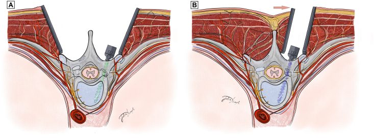 Axial drawing of the open posterior approach for scoliosis fusion, with a midline incision and bilateral detachment of the paraspinal muscle