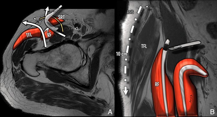 MRI based illustration of the direct anterior approach through the interval between sartorius and tensor fascia lata, exposing rectus femori