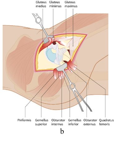 Posterior exposure of the hip through the oblique incision of Kocher, with the gluteal muscles retracted and the short external rotators fro