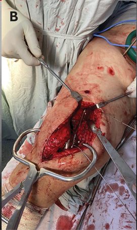 Anteromedial approach to the distal femur through a long medial incision, with a large periarticular clamp holding the reduction