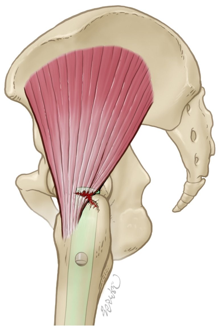 Drawing of an antegrade nail entering at the tip of the greater trochanter through the gluteus medius insertion, where the abductor tendon c
